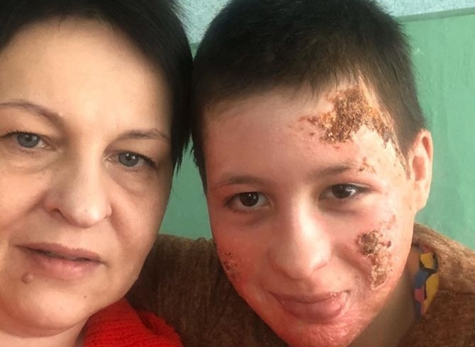 Чернівчанці, яку підпалив батько,  провели пластичну операцію у Києві