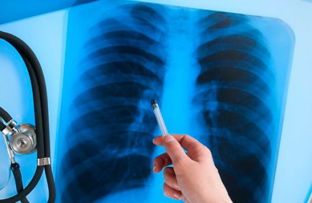 В Україні за місяць – майже тисяча випадків туберкульозу